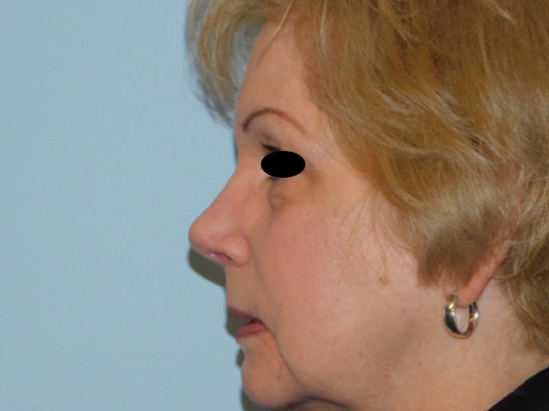 Rhinoplasty Before & After Gallery - Patient 133066390 - Image 10