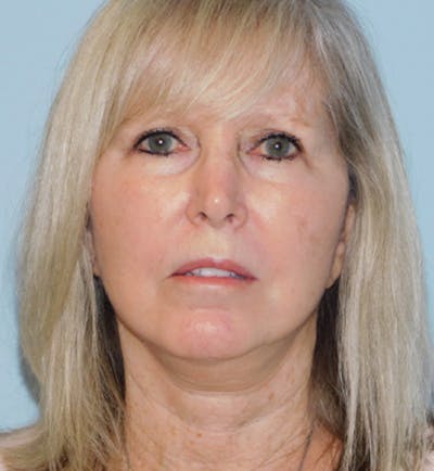 Mini-Facelift Before & After Gallery - Patient 133066392 - Image 2