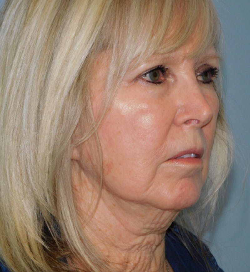 Mini-Facelift Before & After Gallery - Patient 133066392 - Image 3