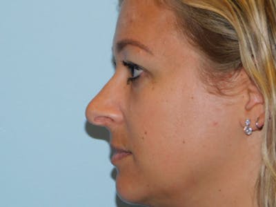 Rhinoplasty Before & After Gallery - Patient 133066396 - Image 1