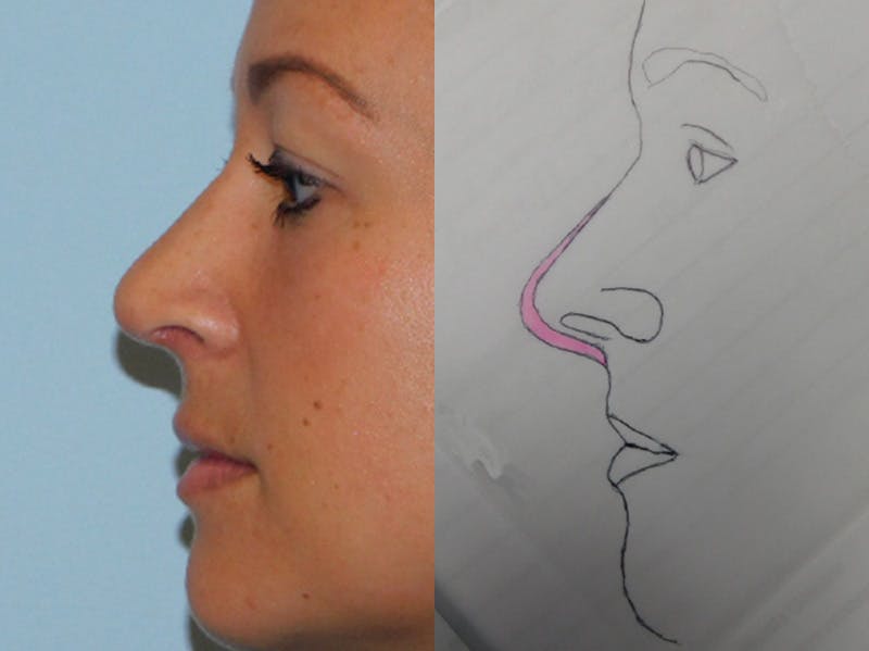 Rhinoplasty Before & After Gallery - Patient 133066396 - Image 2