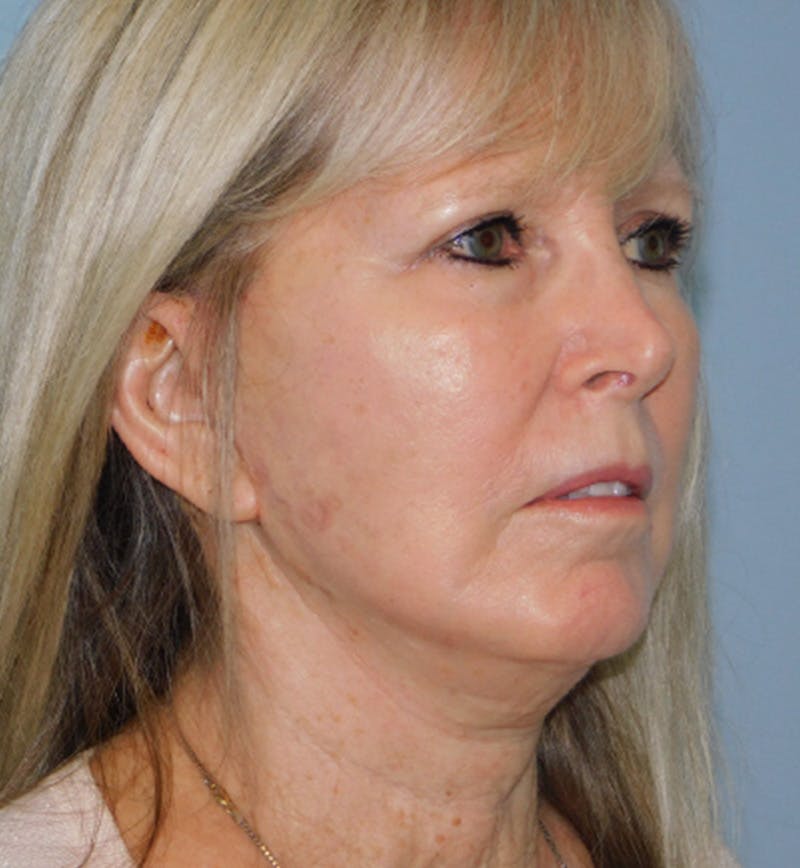 Mini-Facelift Before & After Gallery - Patient 133066392 - Image 4