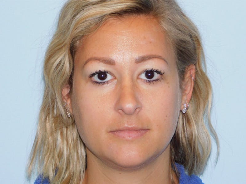Rhinoplasty Before & After Gallery - Patient 133066396 - Image 3