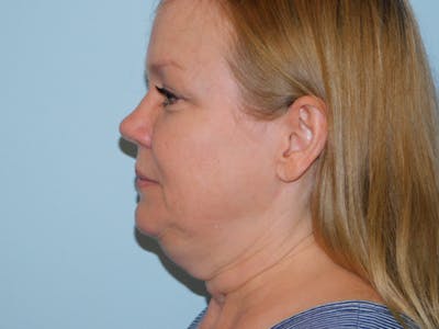 Neck (Submental) Liposuction Before & After Gallery - Patient 133066394 - Image 1