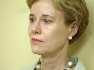 Mini-Facelift Before & After Gallery - Patient 133066397 - Image 1