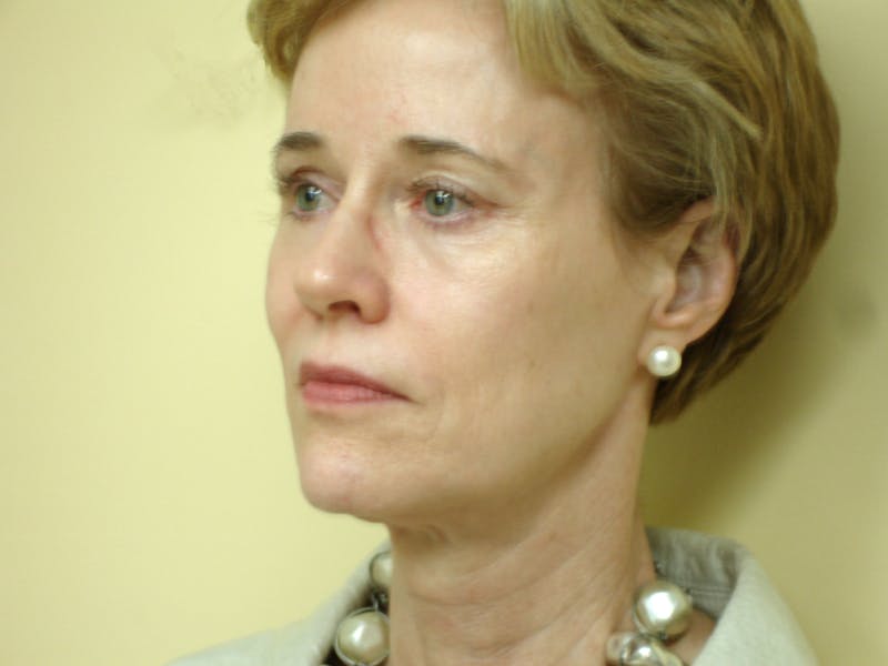 Mini-Facelift Before & After Gallery - Patient 133066397 - Image 1