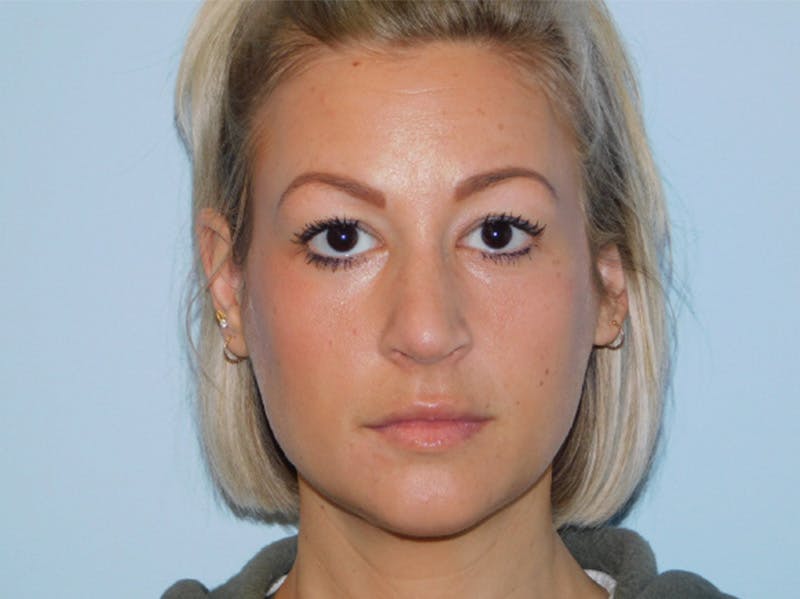 Rhinoplasty Before & After Gallery - Patient 133066396 - Image 4