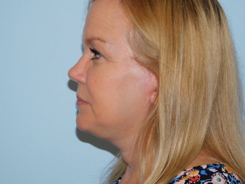 Neck (Submental) Liposuction Before & After Gallery - Patient 133066394 - Image 2