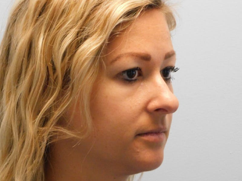 Rhinoplasty Before & After Gallery - Patient 133066396 - Image 5