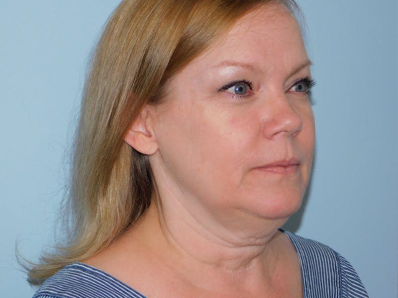 Neck (Submental) Liposuction Before & After Gallery - Patient 133066394 - Image 3