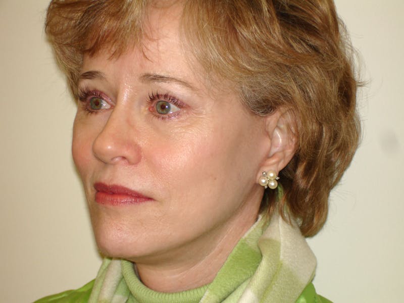 Mini-Facelift Before & After Gallery - Patient 133066397 - Image 2