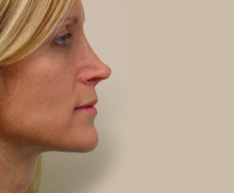 Revision Rhinoplasty Before & After Gallery - Patient 133066402 - Image 1