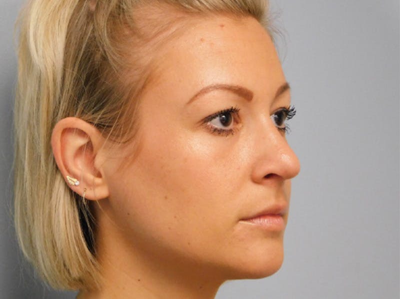 Rhinoplasty Before & After Gallery - Patient 133066396 - Image 6