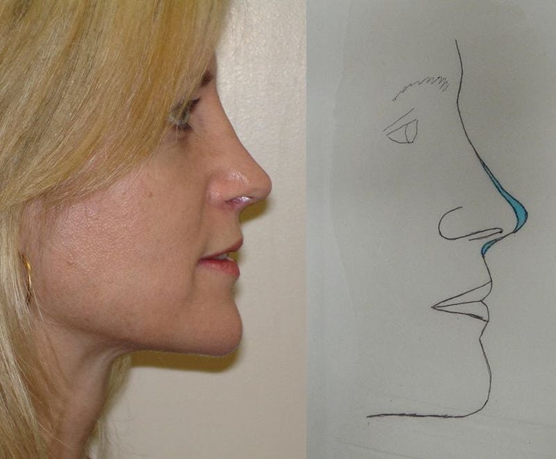 Revision Rhinoplasty Before & After Gallery - Patient 133066402 - Image 2