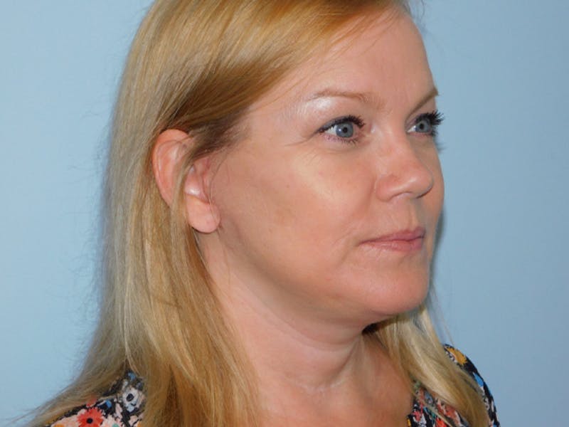 Neck (Submental) Liposuction Before & After Gallery - Patient 133066394 - Image 4