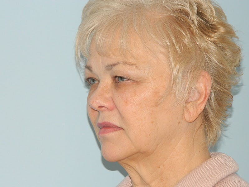 Facelift Before & After Gallery - Patient 133066395 - Image 3