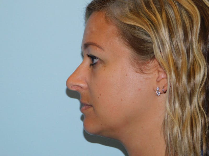 Rhinoplasty Before & After Gallery - Patient 133066396 - Image 7