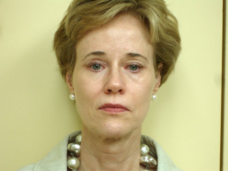 Mini-Facelift Before & After Gallery - Patient 133066397 - Image 3
