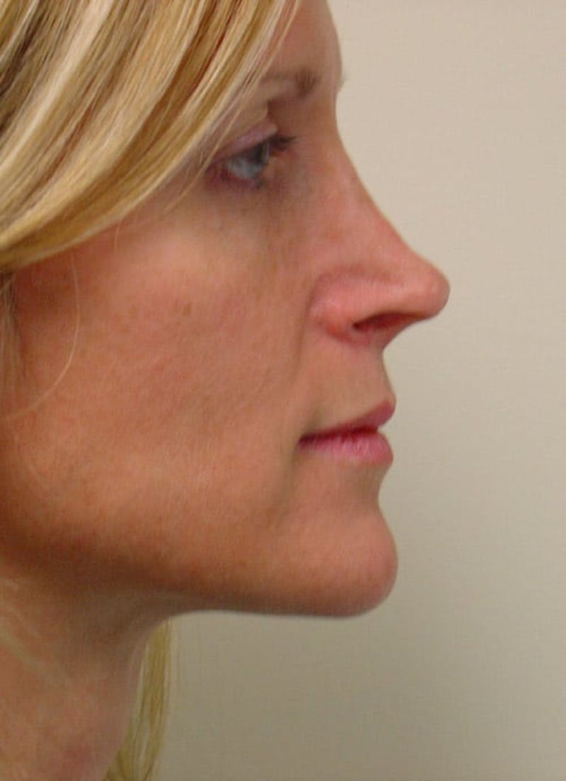Revision Rhinoplasty Before & After Gallery - Patient 133066402 - Image 3