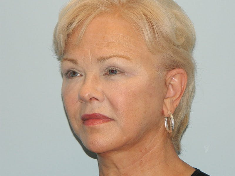 Facelift Before & After Gallery - Patient 133066395 - Image 4