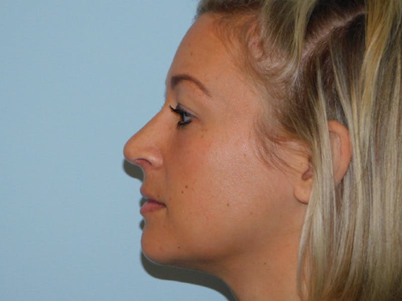 Rhinoplasty Before & After Gallery - Patient 133066396 - Image 8