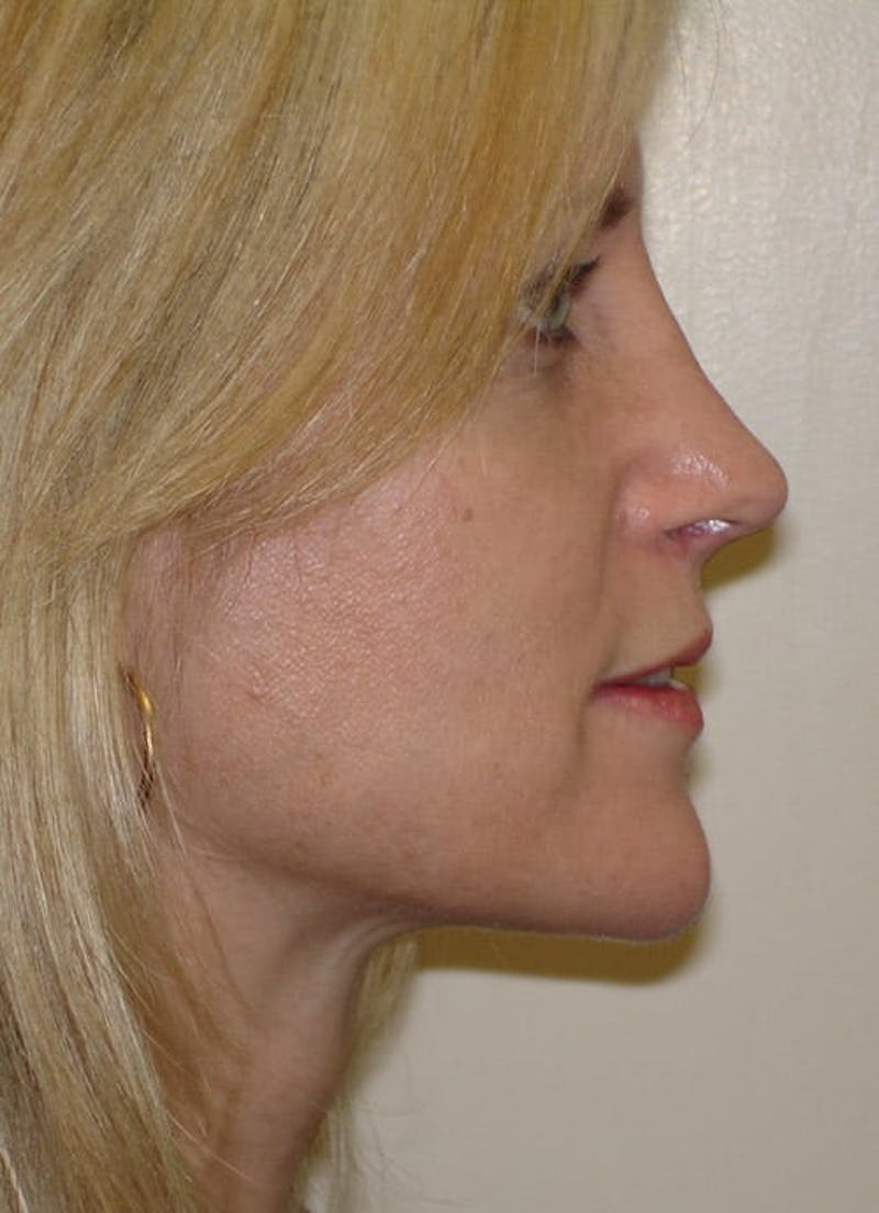 Revision Rhinoplasty Before & After Gallery - Patient 133066402 - Image 4