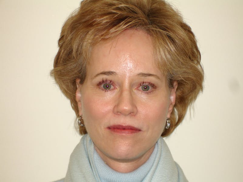 Mini-Facelift Before & After Gallery - Patient 133066397 - Image 4