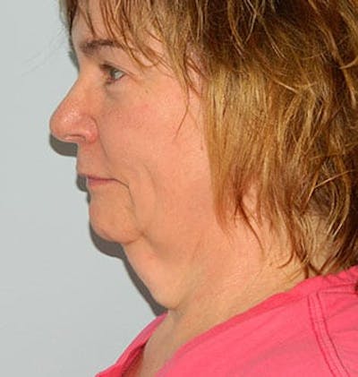 Facelift Before & After Gallery - Patient 133066399 - Image 1