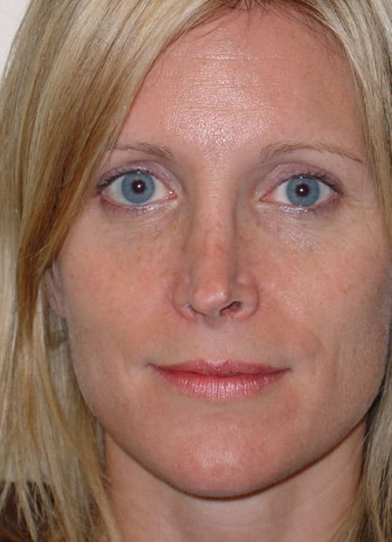Revision Rhinoplasty Before & After Gallery - Patient 133066402 - Image 5