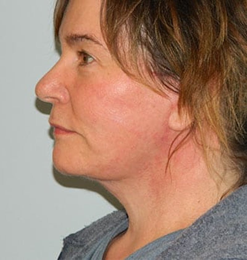 Facelift Before & After Gallery - Patient 133066399 - Image 2