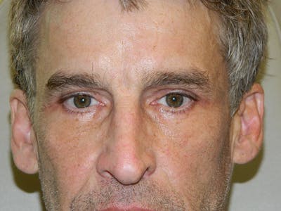 Blepharoplasty (Eyelid Lift) Before & After Gallery - Patient 133066398 - Image 2