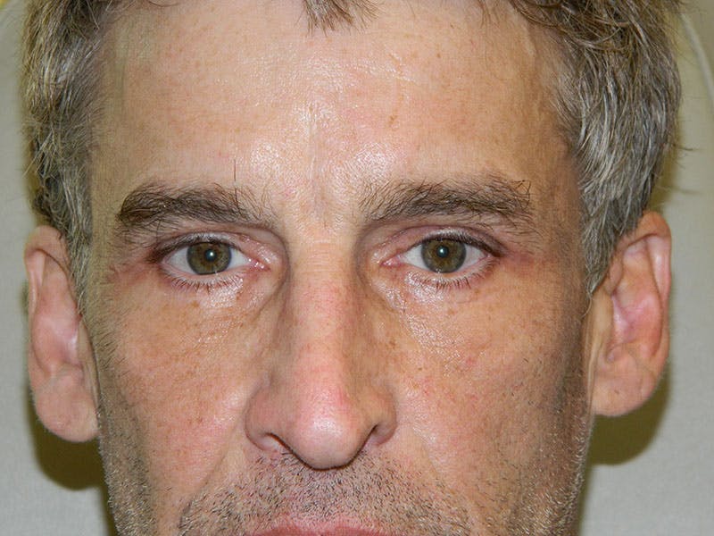 Blepharoplasty (Eyelid Lift) Before & After Gallery - Patient 133066398 - Image 2