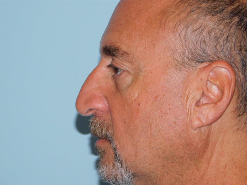Rhinoplasty Before & After Gallery - Patient 133066404 - Image 1