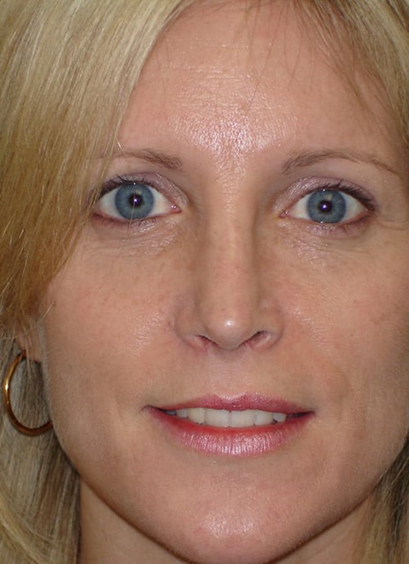 Revision Rhinoplasty Before & After Gallery - Patient 133066402 - Image 6