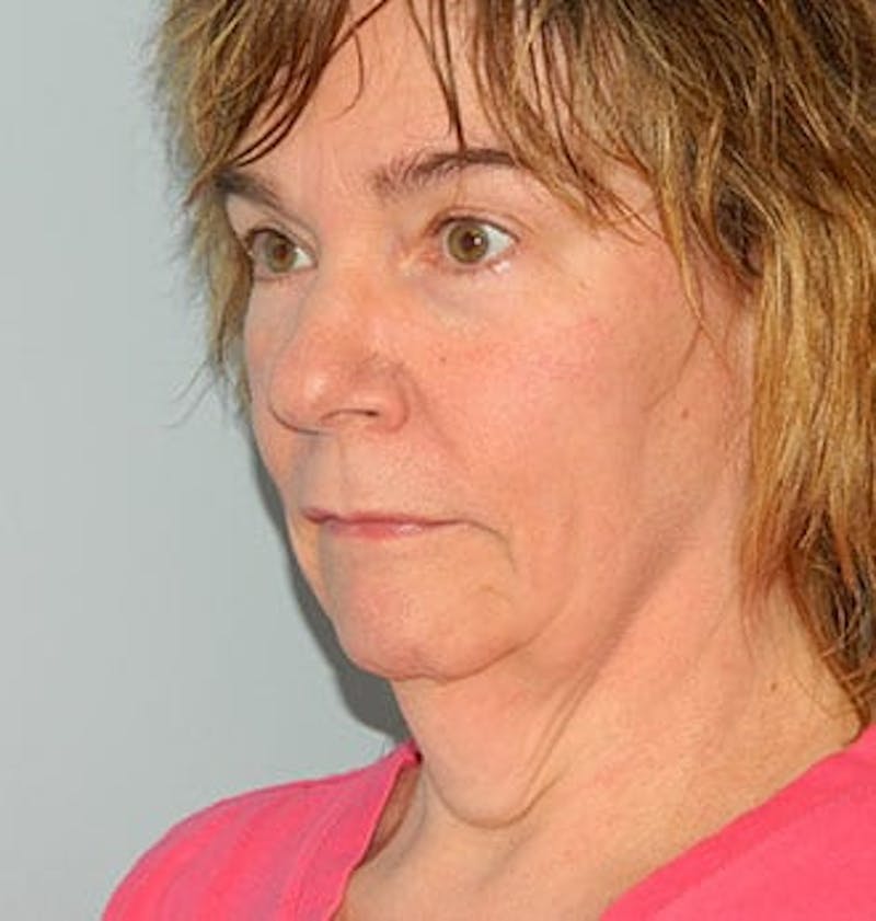 Facelift Before & After Gallery - Patient 133066399 - Image 3