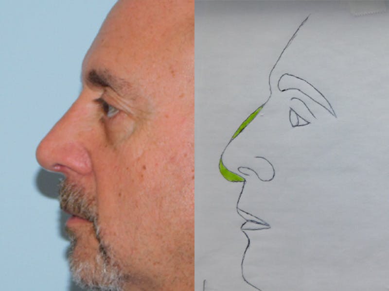 Rhinoplasty Before & After Gallery - Patient 133066404 - Image 2