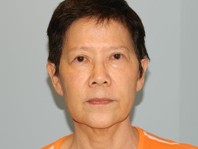 Mini-Facelift Before & After Gallery - Patient 133066405 - Image 1