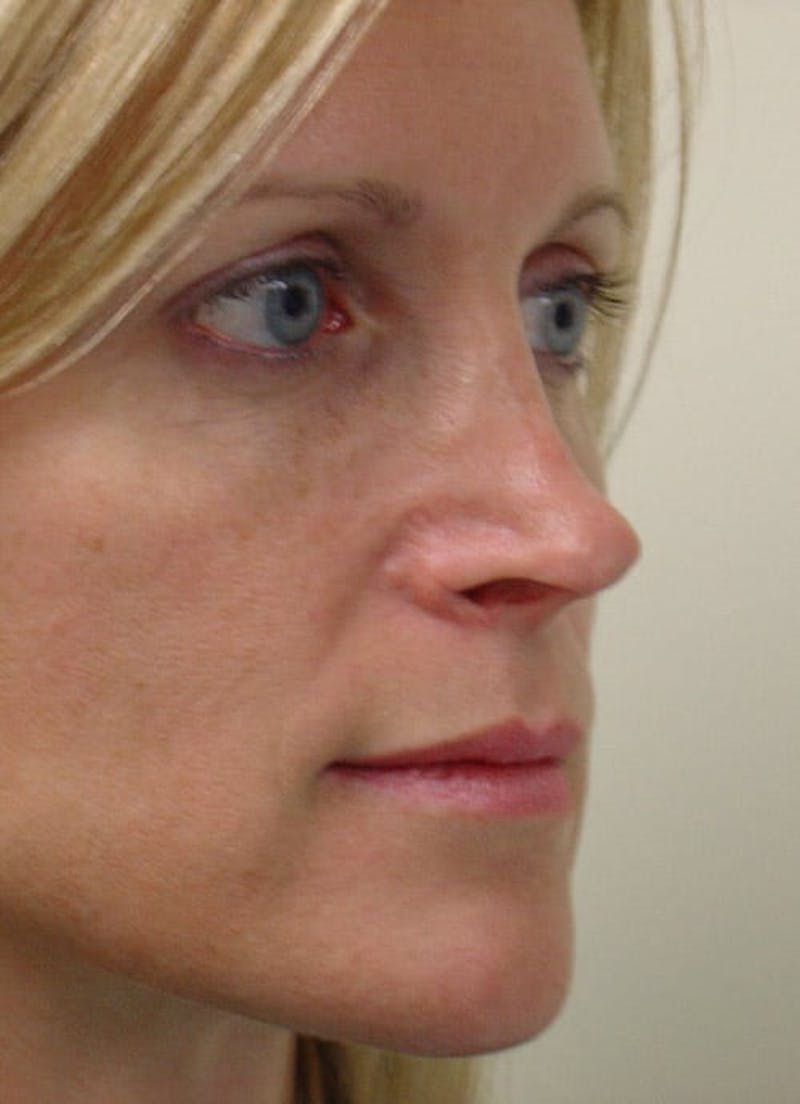 Revision Rhinoplasty Before & After Gallery - Patient 133066402 - Image 7