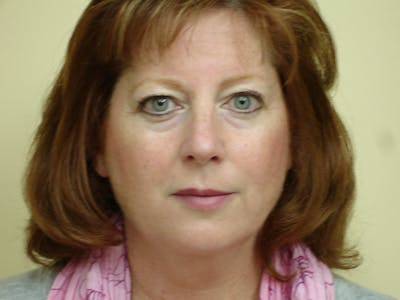 Blepharoplasty (Eyelid Lift) Before & After Gallery - Patient 133066401 - Image 1
