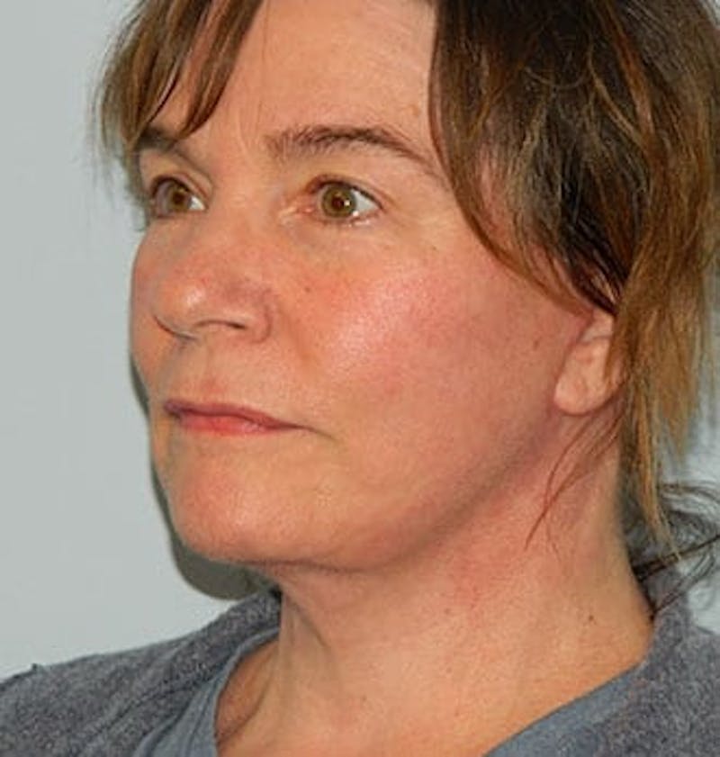 Facelift Before & After Gallery - Patient 133066399 - Image 4