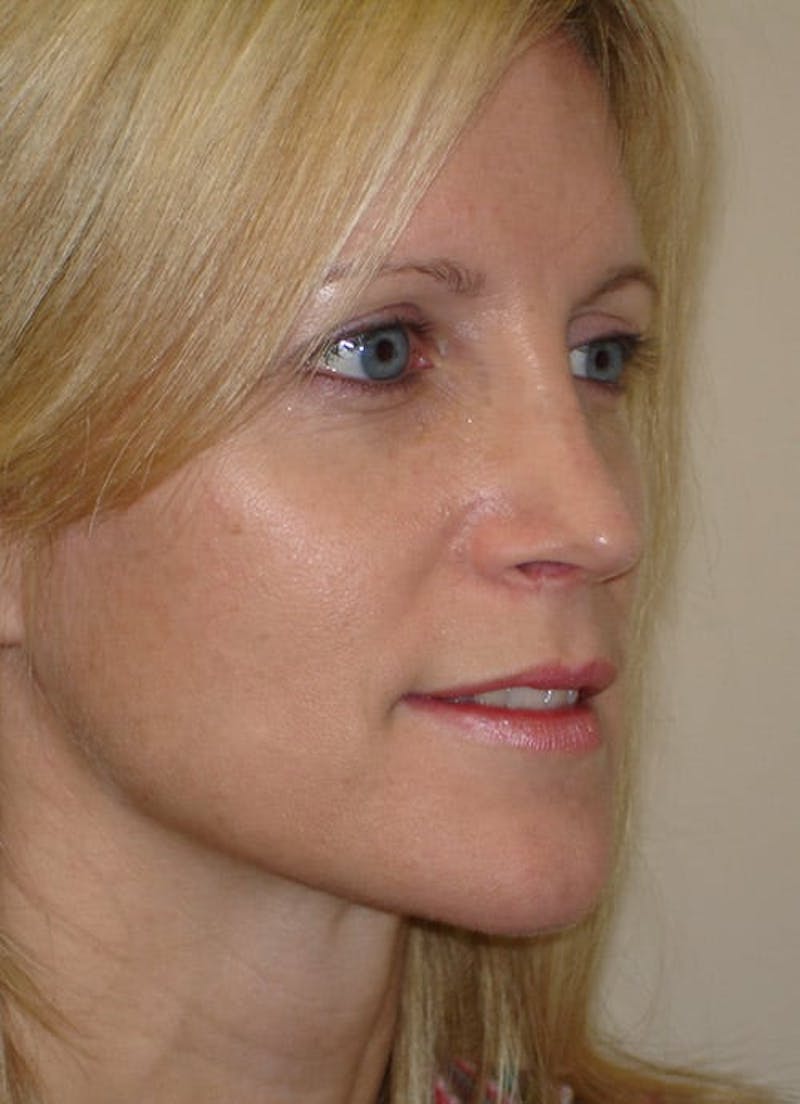 Revision Rhinoplasty Before & After Gallery - Patient 133066402 - Image 8