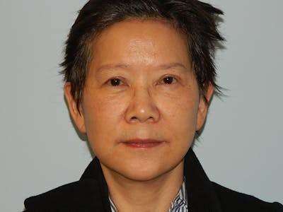 Mini-Facelift Before & After Gallery - Patient 133066405 - Image 2