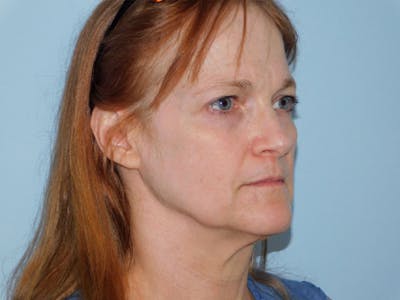 Facelift Before & After Gallery - Patient 133066406 - Image 1