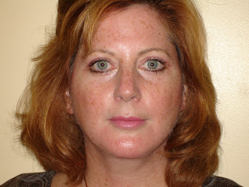 Blepharoplasty (Eyelid Lift) Before & After Gallery - Patient 133066401 - Image 2