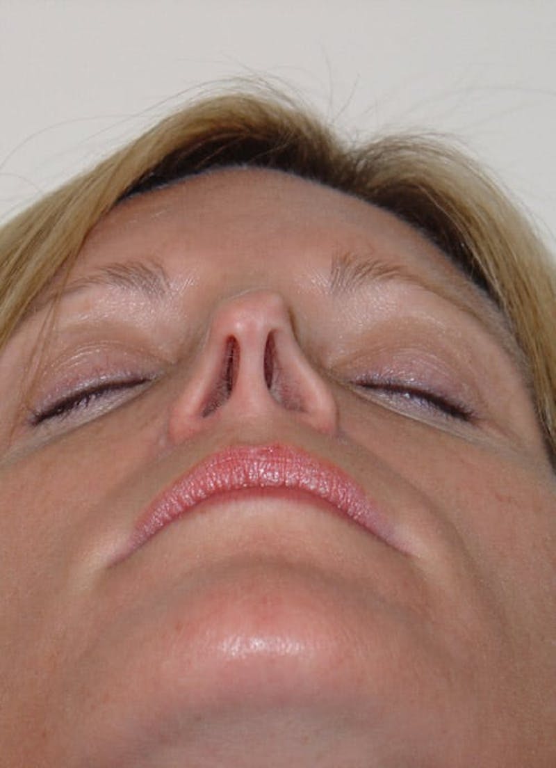 Revision Rhinoplasty Before & After Gallery - Patient 133066402 - Image 9