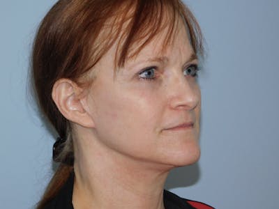 Facelift Before & After Gallery - Patient 133066406 - Image 2