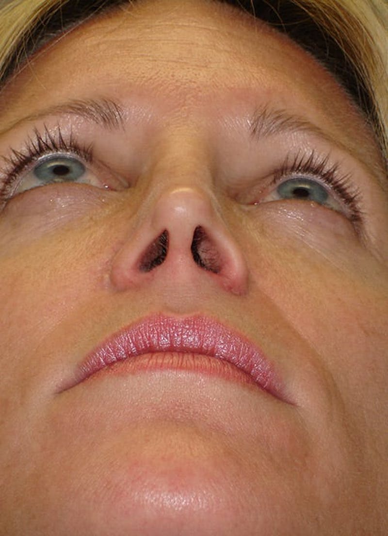 Revision Rhinoplasty Before & After Gallery - Patient 133066402 - Image 10