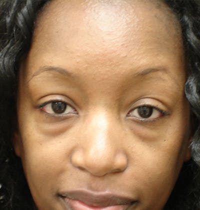 Blepharoplasty (Eyelid Lift) Before & After Gallery - Patient 133066403 - Image 1