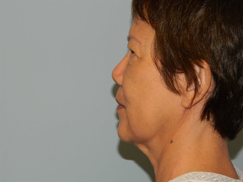 Mini-Facelift Before & After Gallery - Patient 133066405 - Image 5