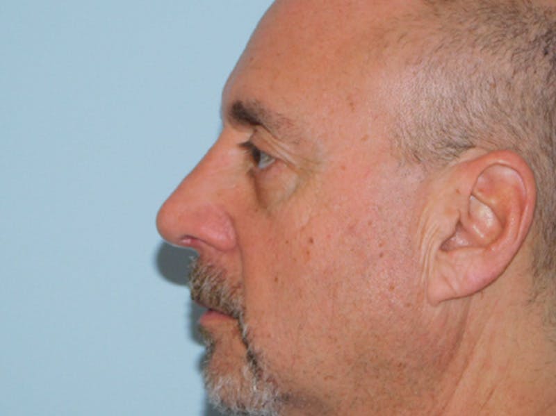 Rhinoplasty Before & After Gallery - Patient 133066404 - Image 6